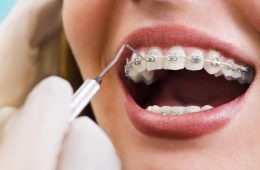 sabit-ortodontik-apareyler